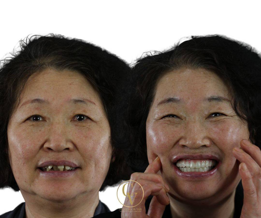 Ormond Dental Implants Dental Implant Before and After Picture 4