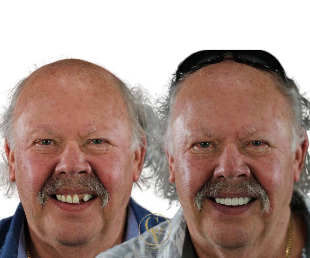 Ormond Dental Implant Success Photo by Ormond Dental Implants