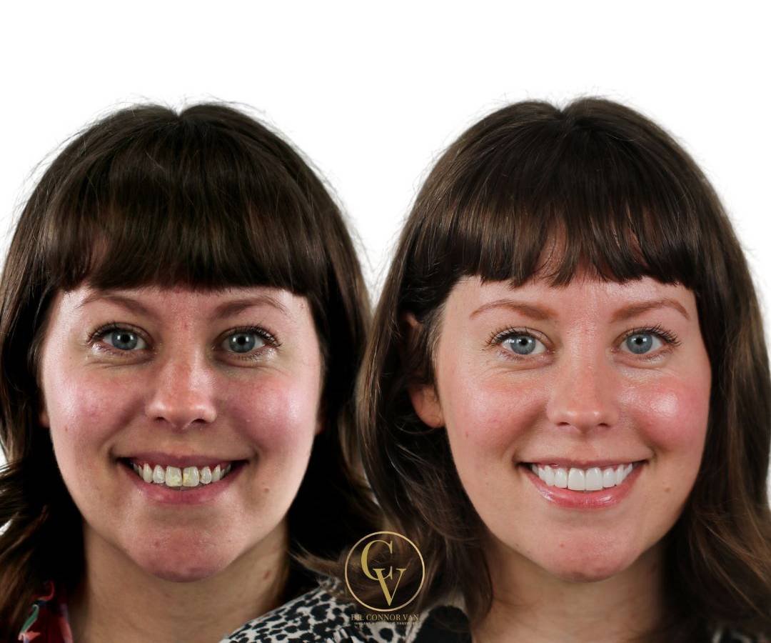 Ormond Dental Implants Dental Implant Photo