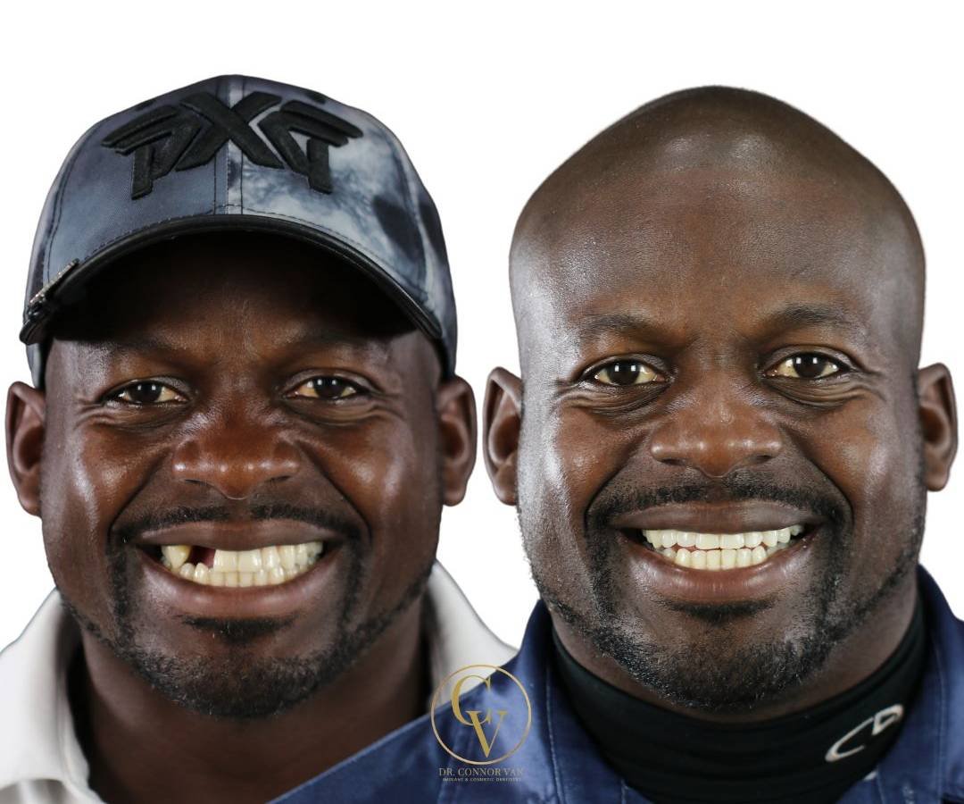 Ormond Dental Implant Makeover by Ormond Dental Implants