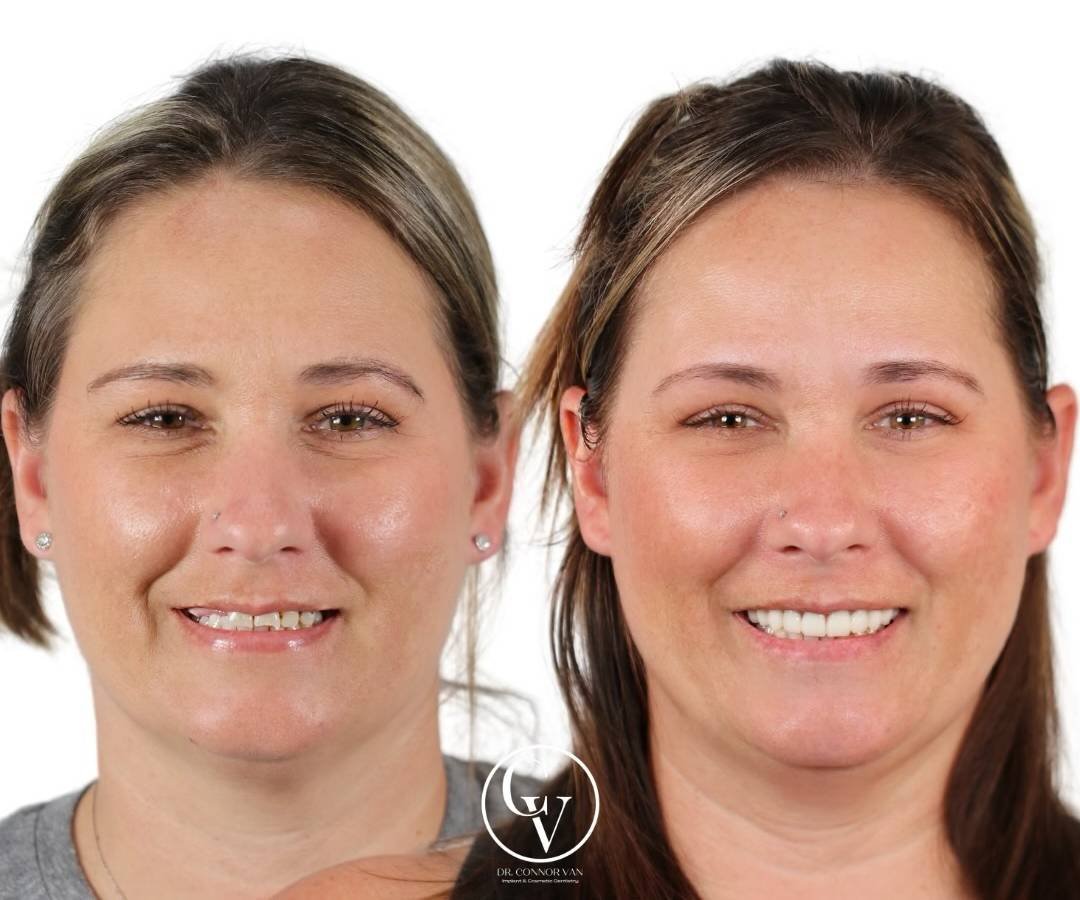 Ormond Dental Implant Success Story by Ormond Dental Implants