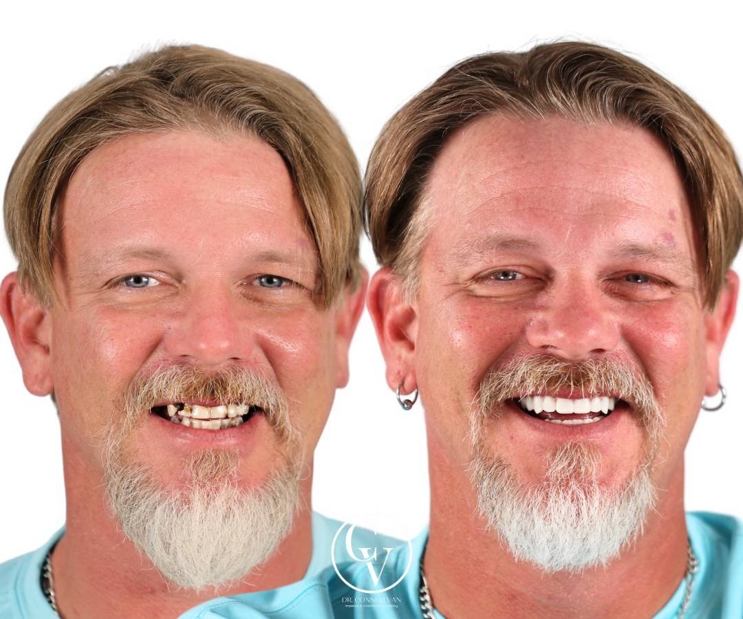 Ormond Dental Implants Dental Implant Transformation