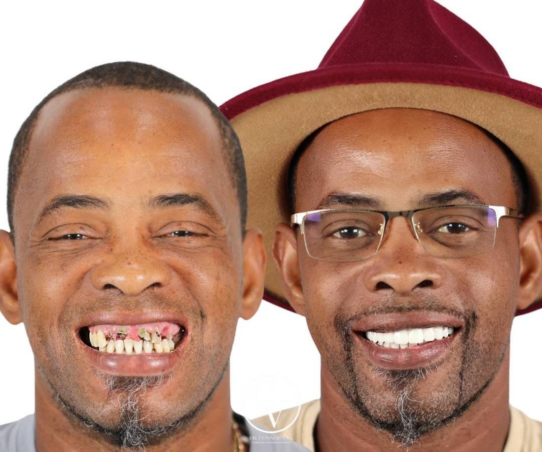 Ormond Dental Implant Before & After Result 15 by Dr. Connor Van